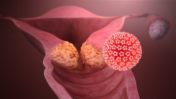 L’Australie sur le point d’eradiquer le cancer du col de l’uterus