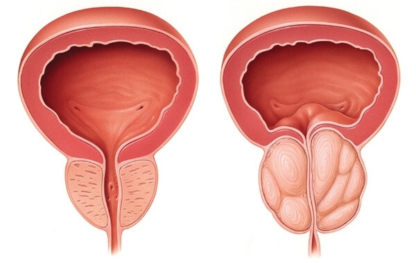 Dépistage du cancer de la prostate : le dosage systématique du PSA n’apporte rien